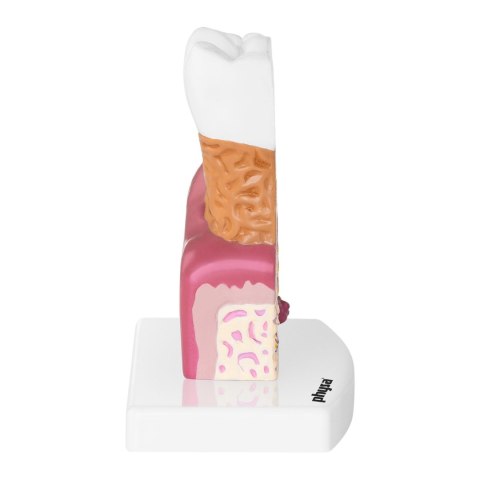 Model anatomiczny chorego zęba człowieka w skali 6:1 Model anatomiczny chorego zęba człowieka w skali 6:1
