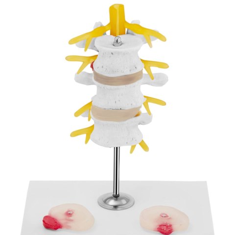 Model anatomiczny 3D odcinka lędźwiowego kręgosłupa z przepukliną kręgi 3-5 Model anatomiczny 3D odcinka lędźwiowego kręgosłupa z przepukliną kręgi 3-5
